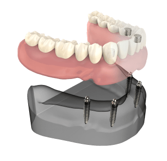 Teeth in a Day Teeth Thumb