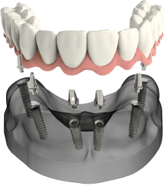 Dental Implant Teeth Thumb